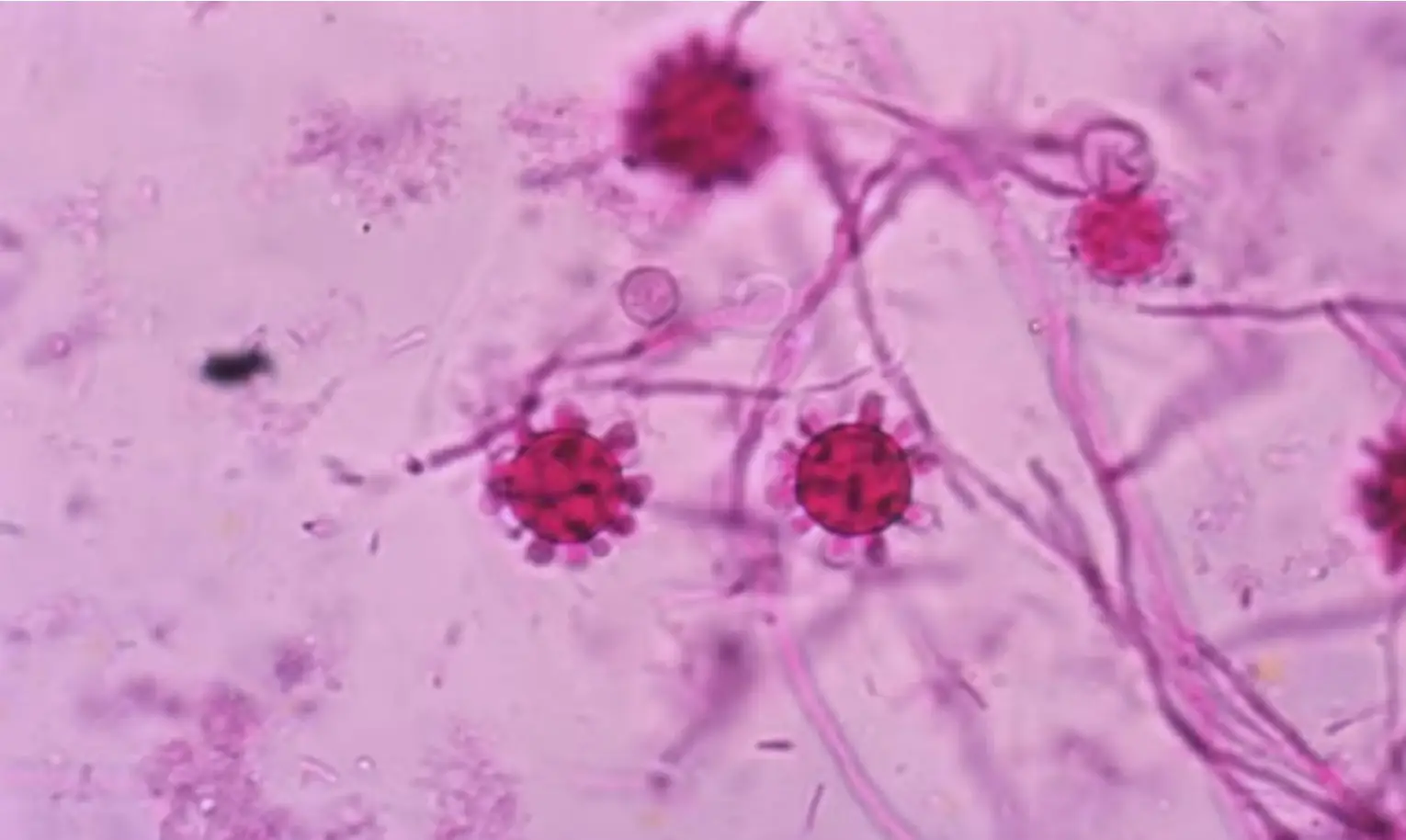 Histoplasma capsulatum fungus (Centers for Disease Control and Prevention)