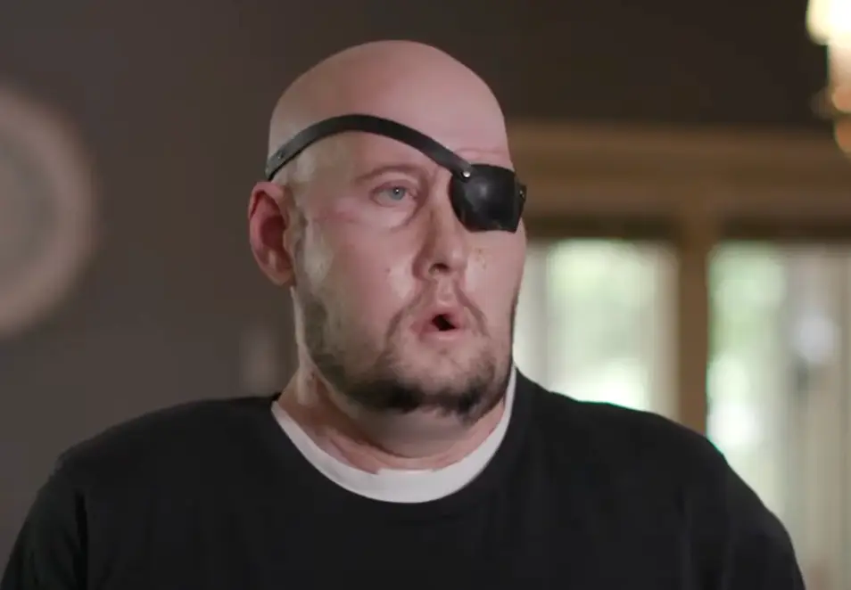 Aaron is now wearing an eye patch to protected the donated eye.