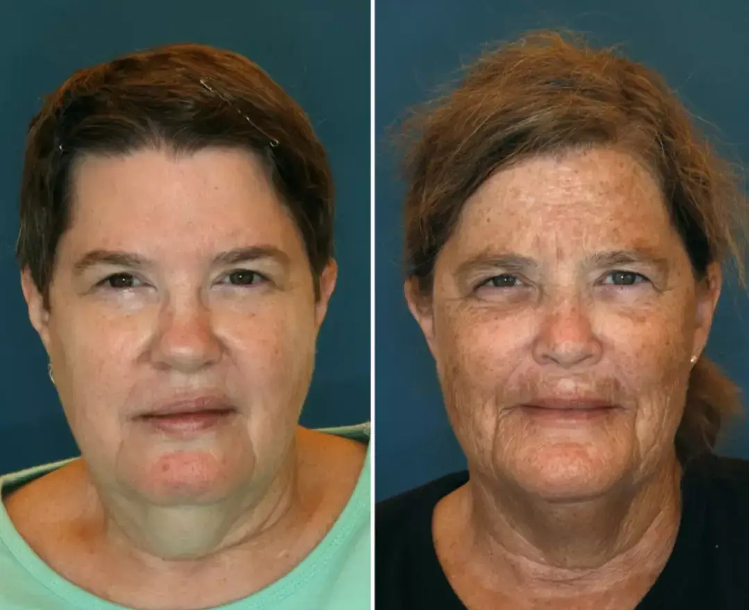 Jeanne (left) and Susan (right) (American Society of Plastic Surgeons / Dr. Bahman Guyuron)