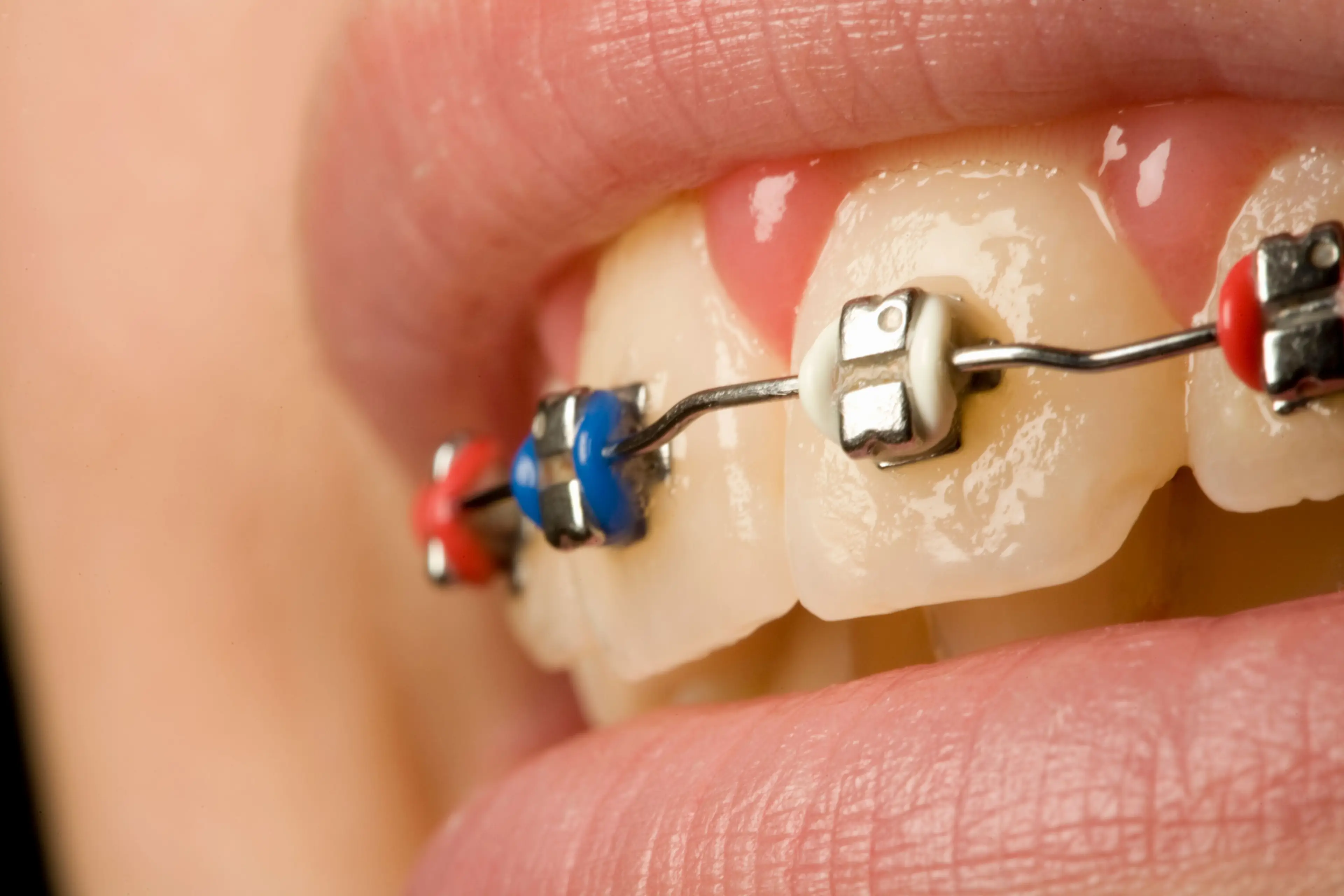 Our ancestors didn't need braces, according to the fossil record. (Getty stock image)