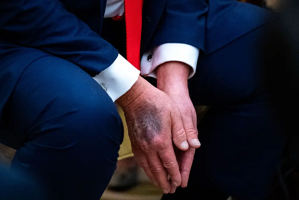 Bruising could be seen on the back of Trump's right hand during a meeting with South Korean President Lee Jae Myung, last Monday (Al Drago/Bloomberg via Getty Images)