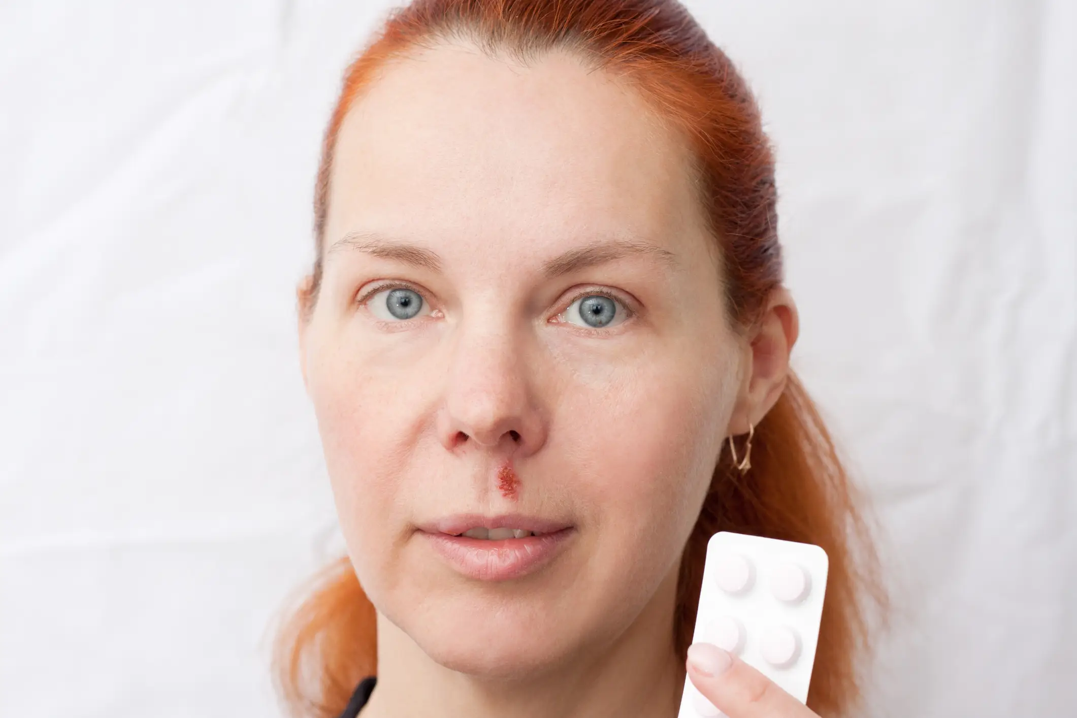 HSV-1 is a lifelong infection that can be treated but not cured (Getty stock)