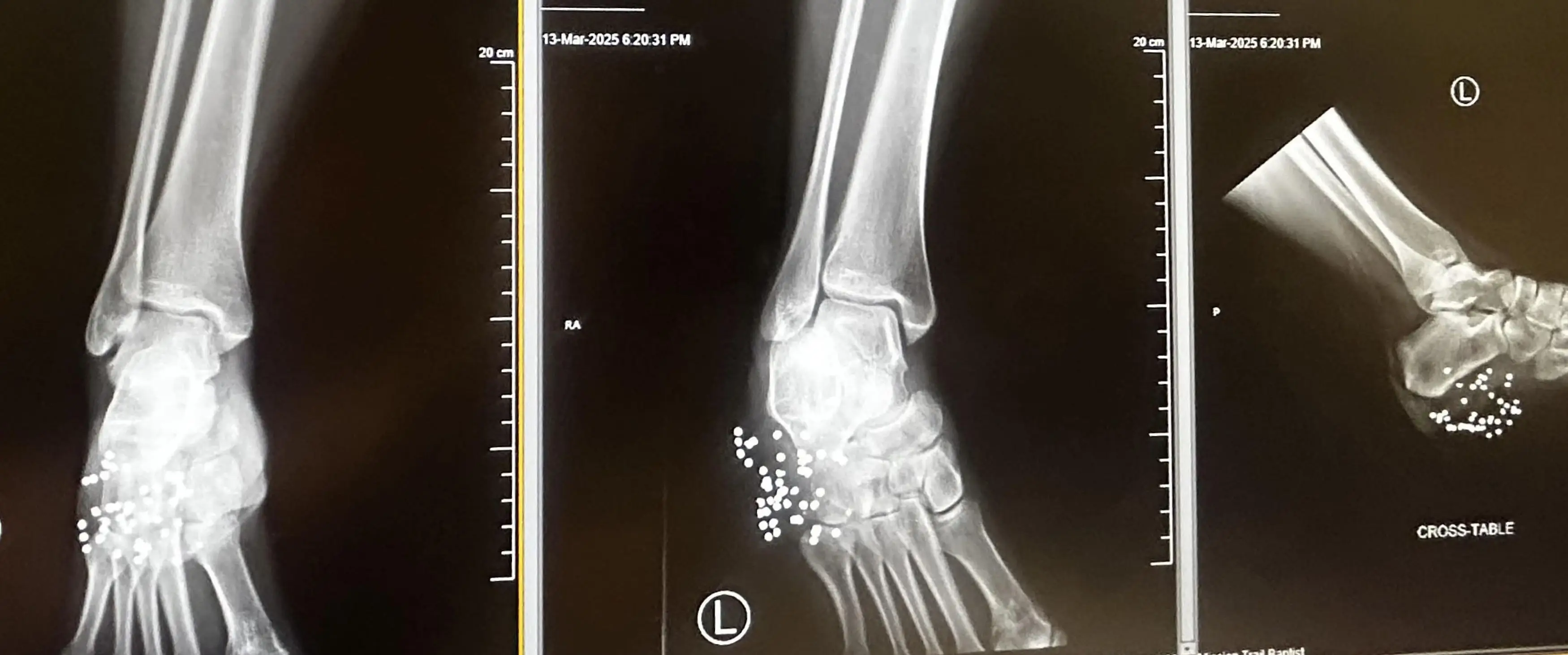 40 pellets went into the mom's foot (Kennedy News and Media) 