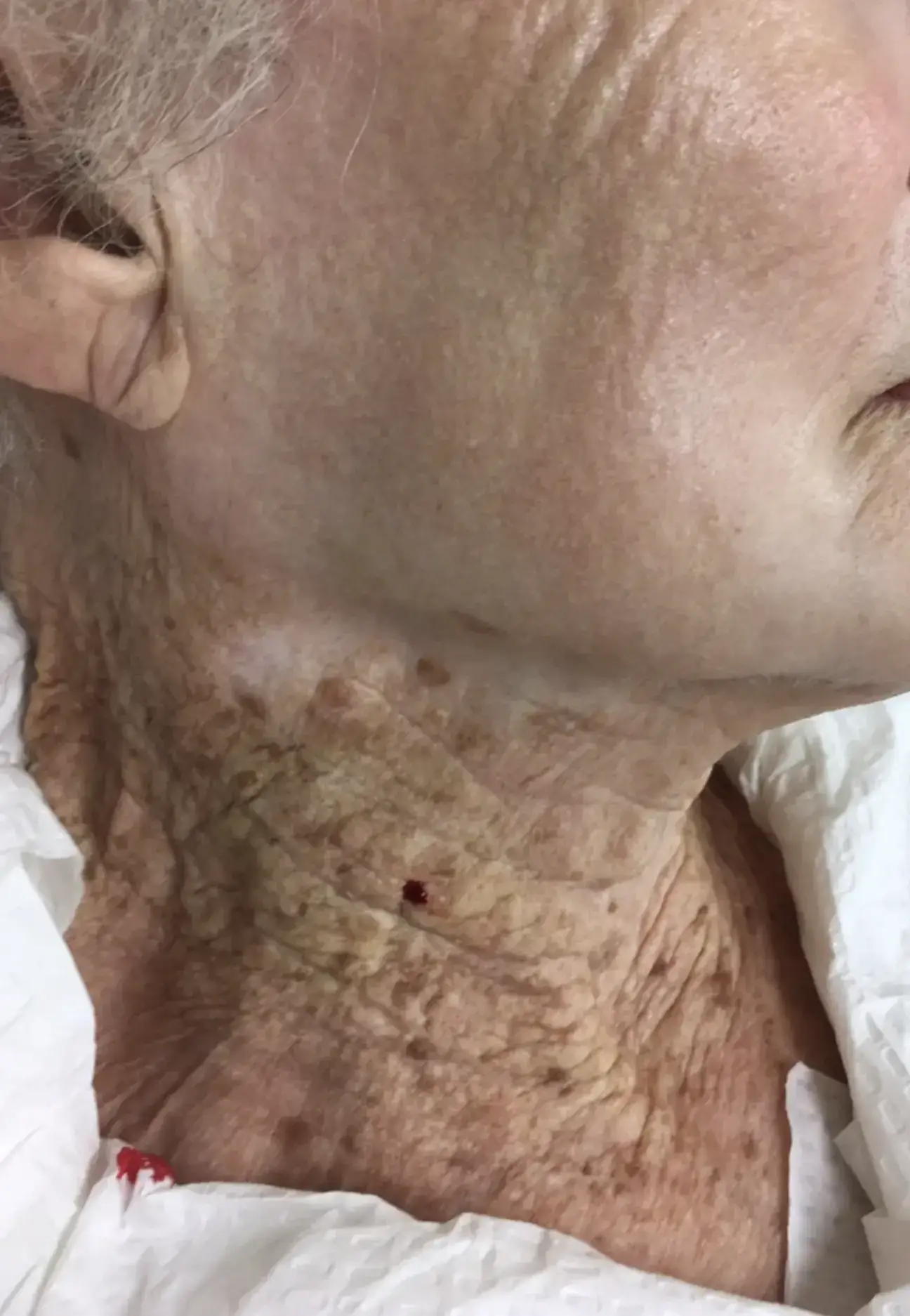 The 92-year-old didn't apply sun cream to her neck.