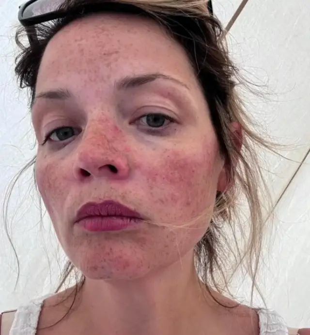 Kirsten said it feels like her body is 'on fire' (ITV)