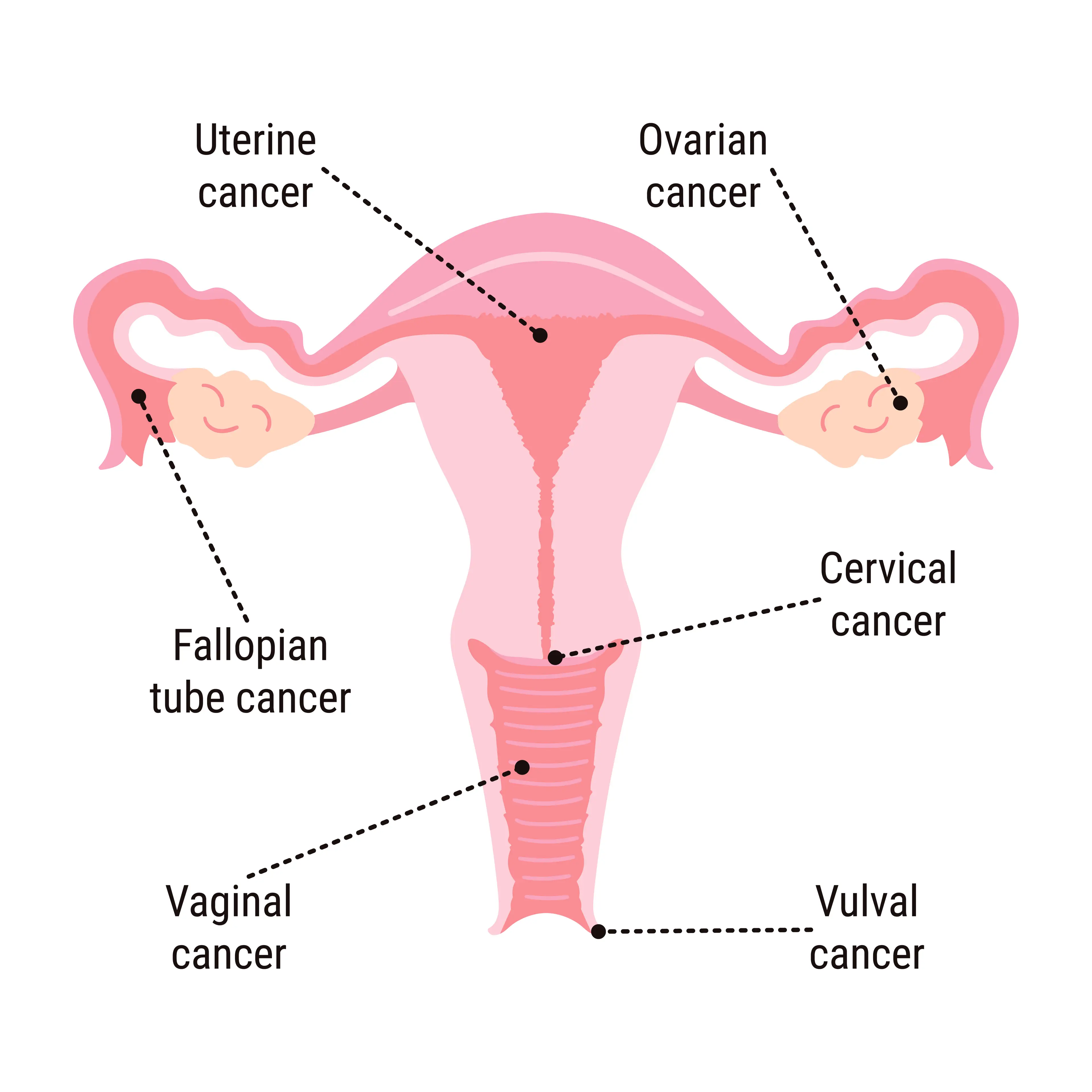 More than 7,000 people are diagnosed with vulval cancer each year (Getty Stock)