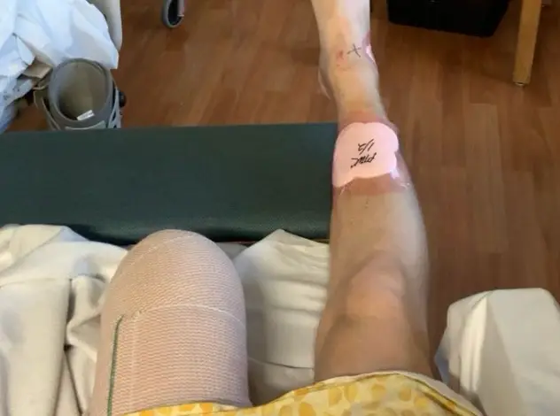 Matthew's leg was amputated after the accident. (Supplied)