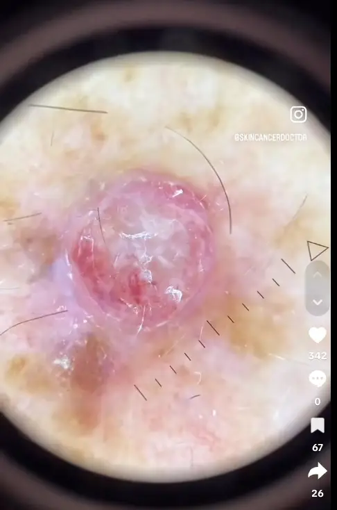 The cancer under the microscope (@‌skincancerdoctor/TikTok)