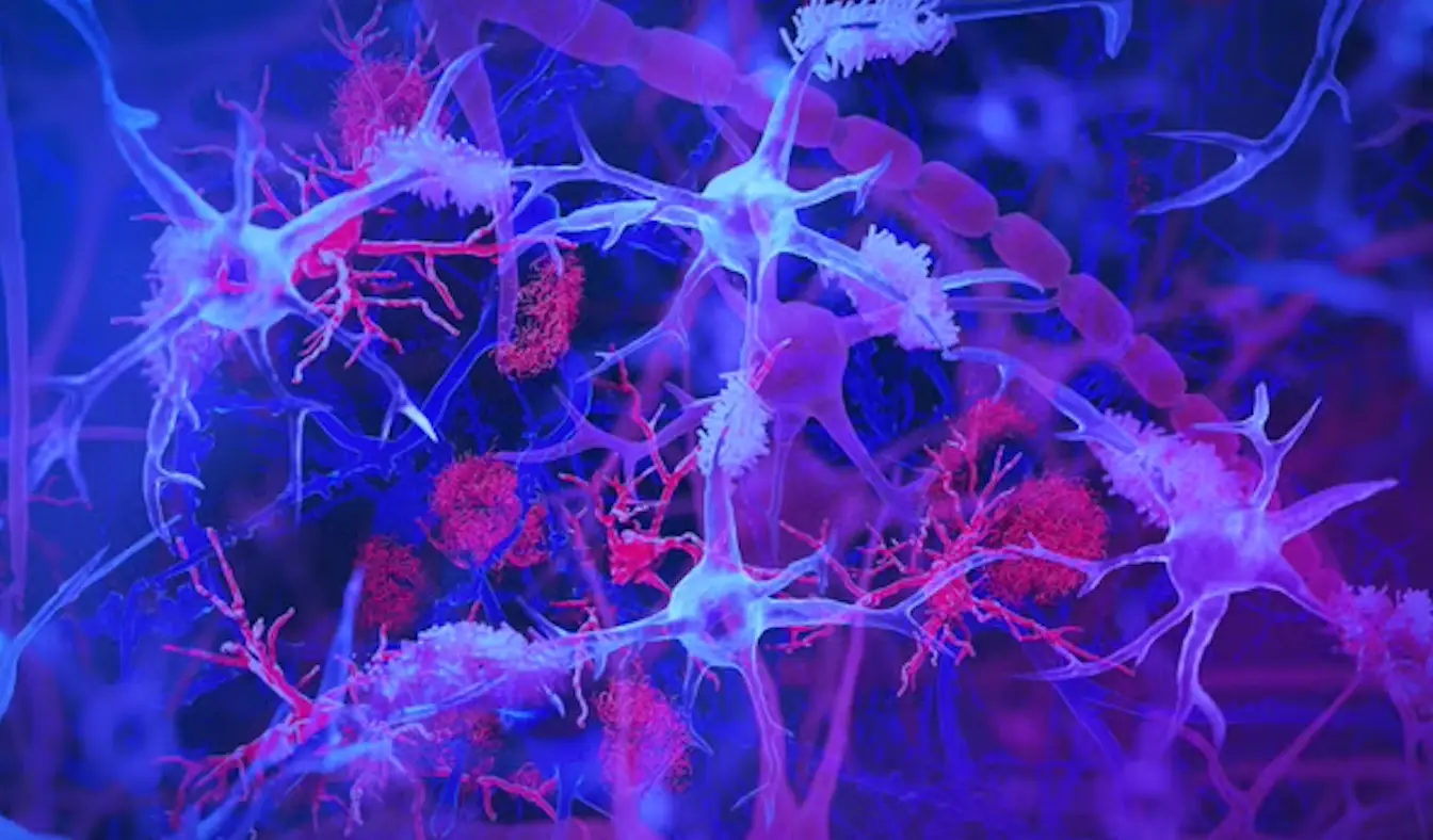 Brain’s immune cells, light blue and purple, shown interacting with amyloid plaques, red, linked to Alzheimer’s disease (Jason Drees/Arizona State University)