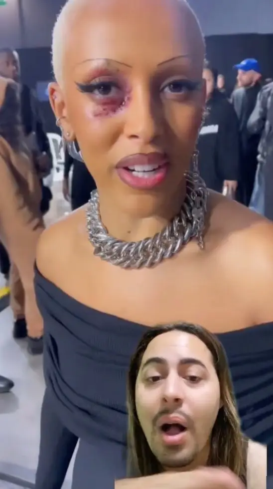 Her 'purple eye' make-up has been the source of speculation.