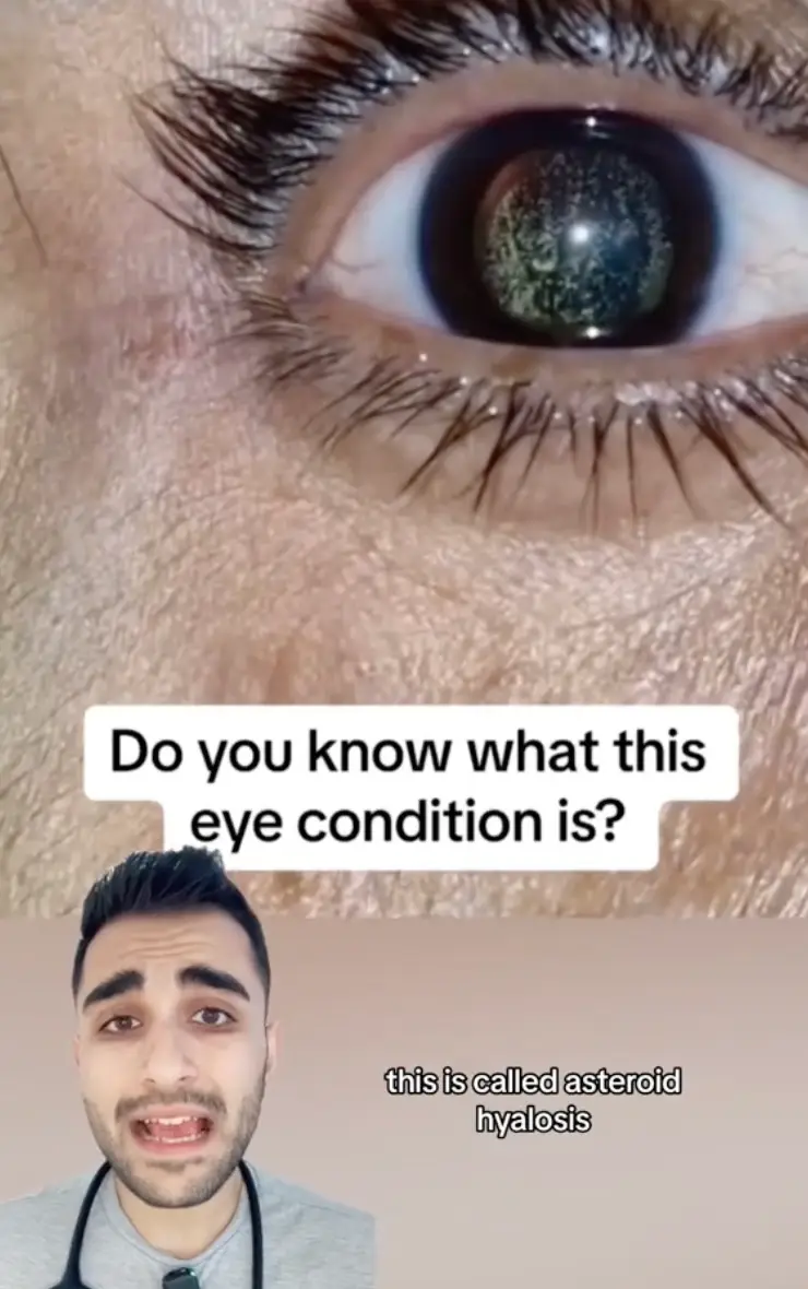 Asteroid hyalosis makes you look like your pupils are a starry night sky. (itsdrmax/TikTok)