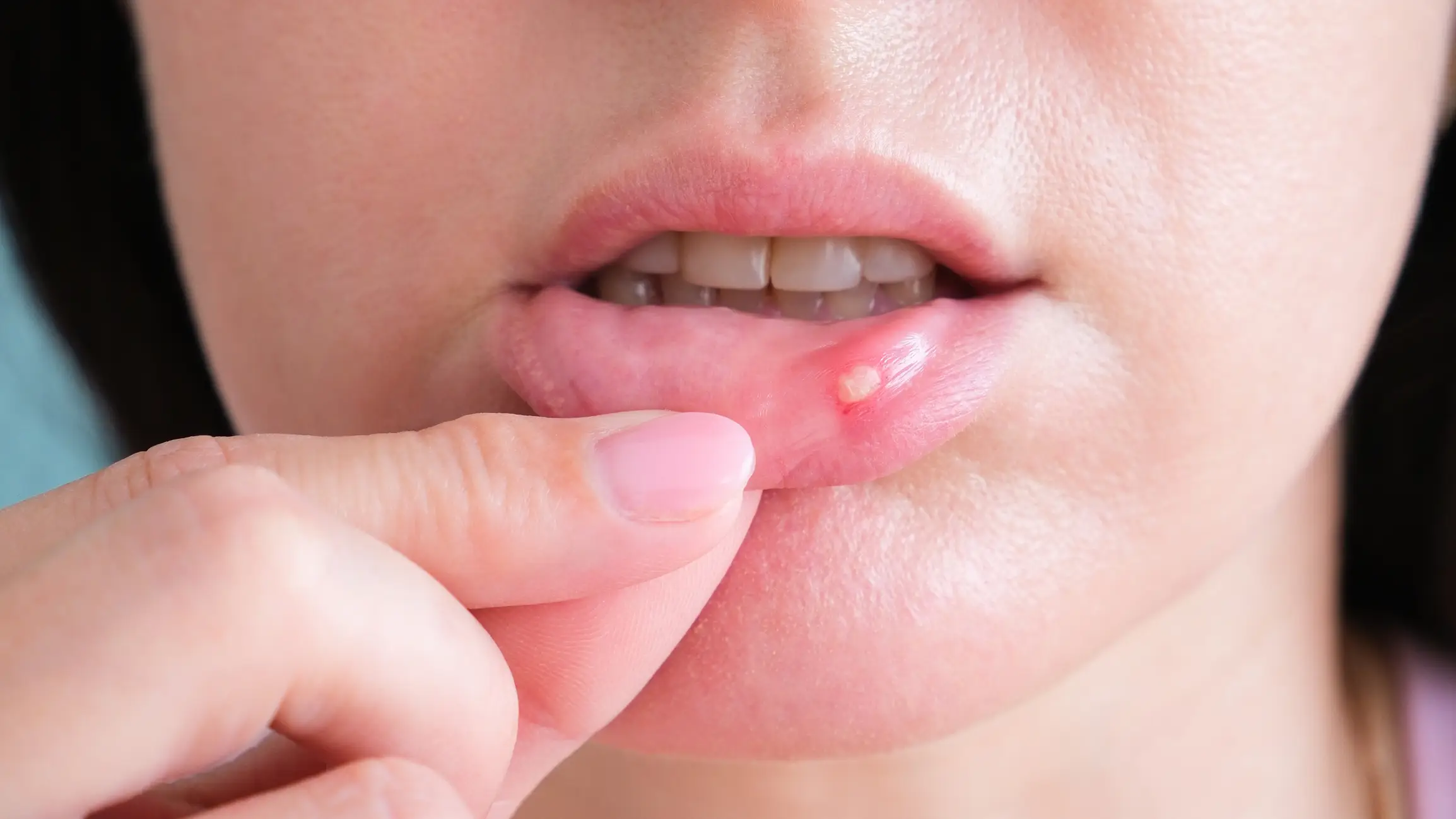 Mouth ulcers can become common (Getty Stock Photo)