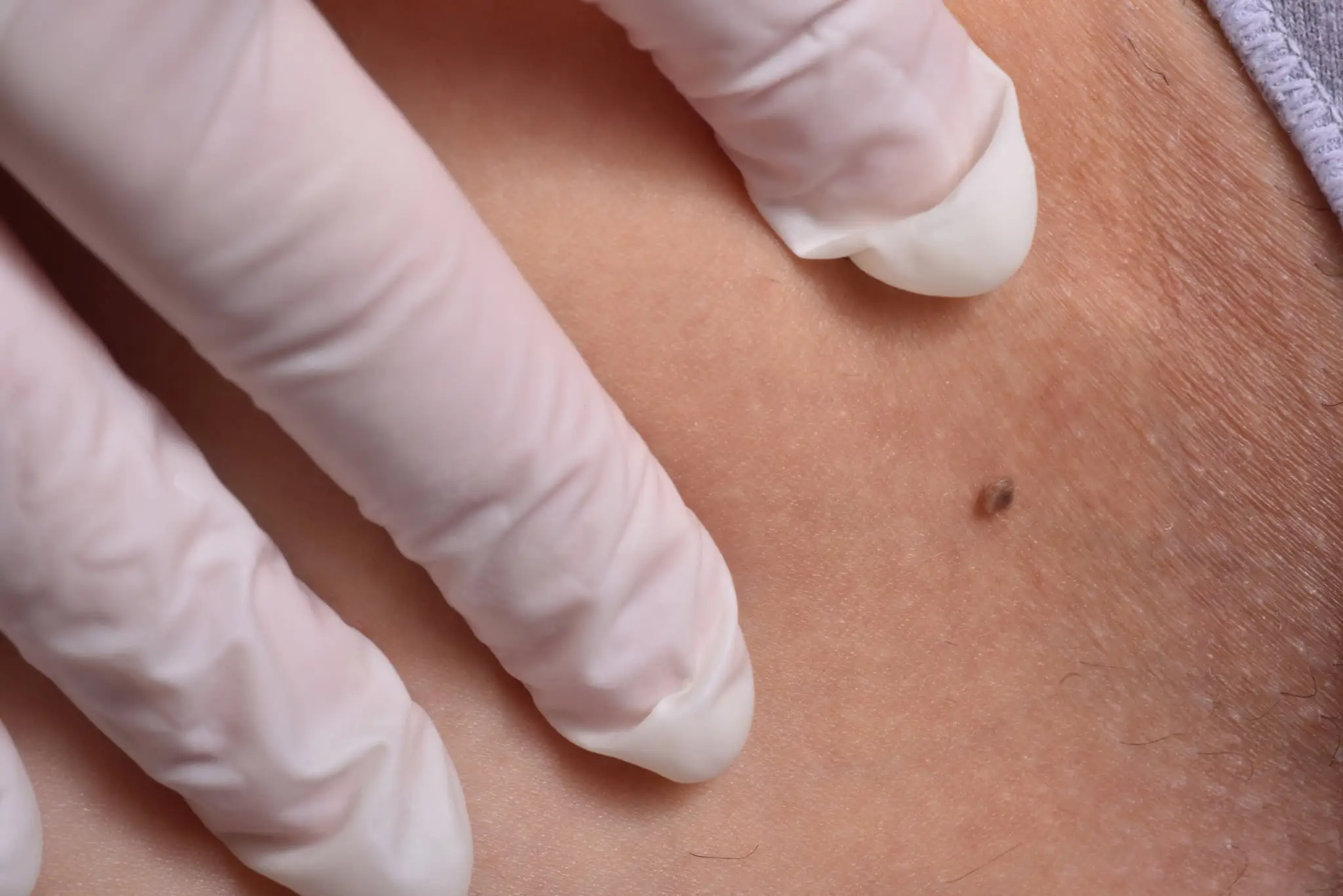 Irregular shaped and uneven toned moles and marks should be checked (Getty Stock Image)