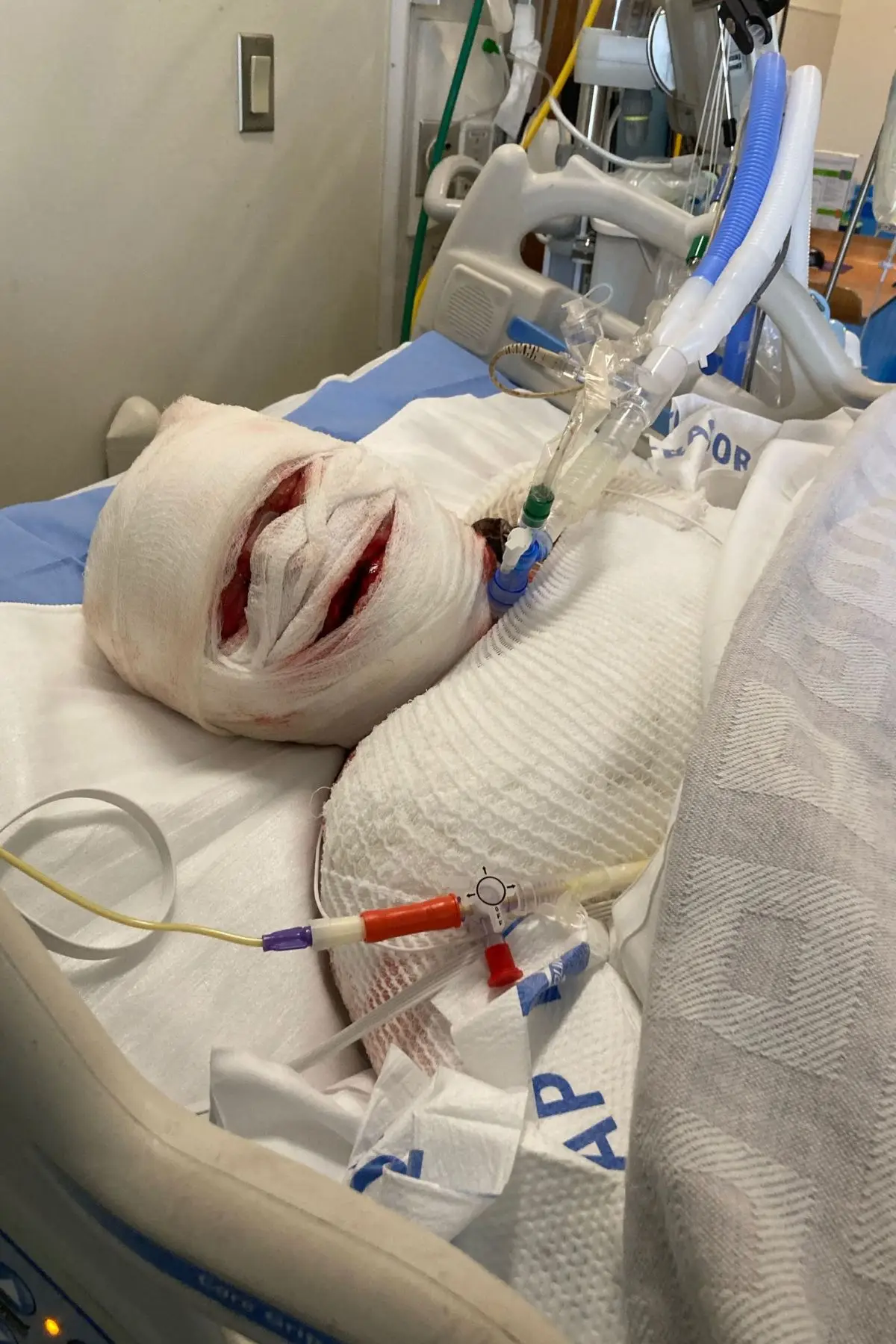 SJS symptoms include a sore throat, painful rashes, blisters, and skin peeling (Kennedy News)