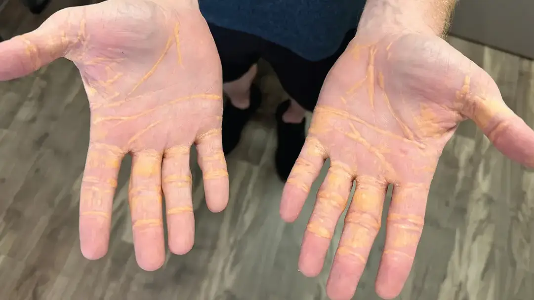 Man who only ate ‘carnivore diet’ for 8 months claimed his health improved despite suffering drastic side effects