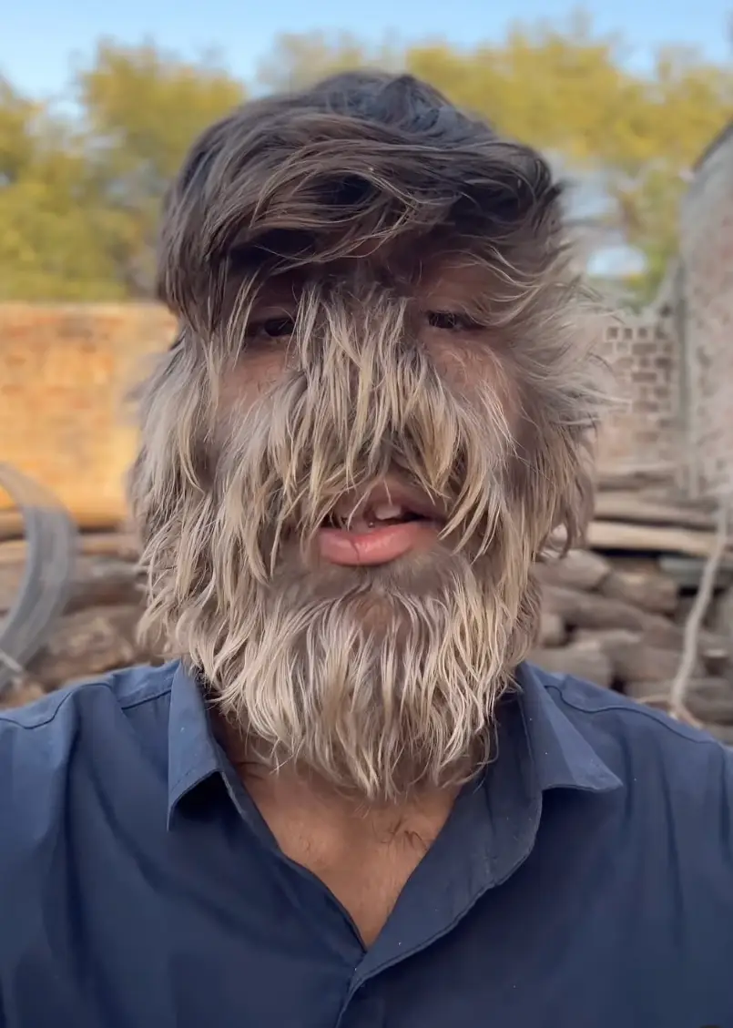 Over 95 percent of the teenager's face is covered in hair (@lalitpatidar520/Instagram)