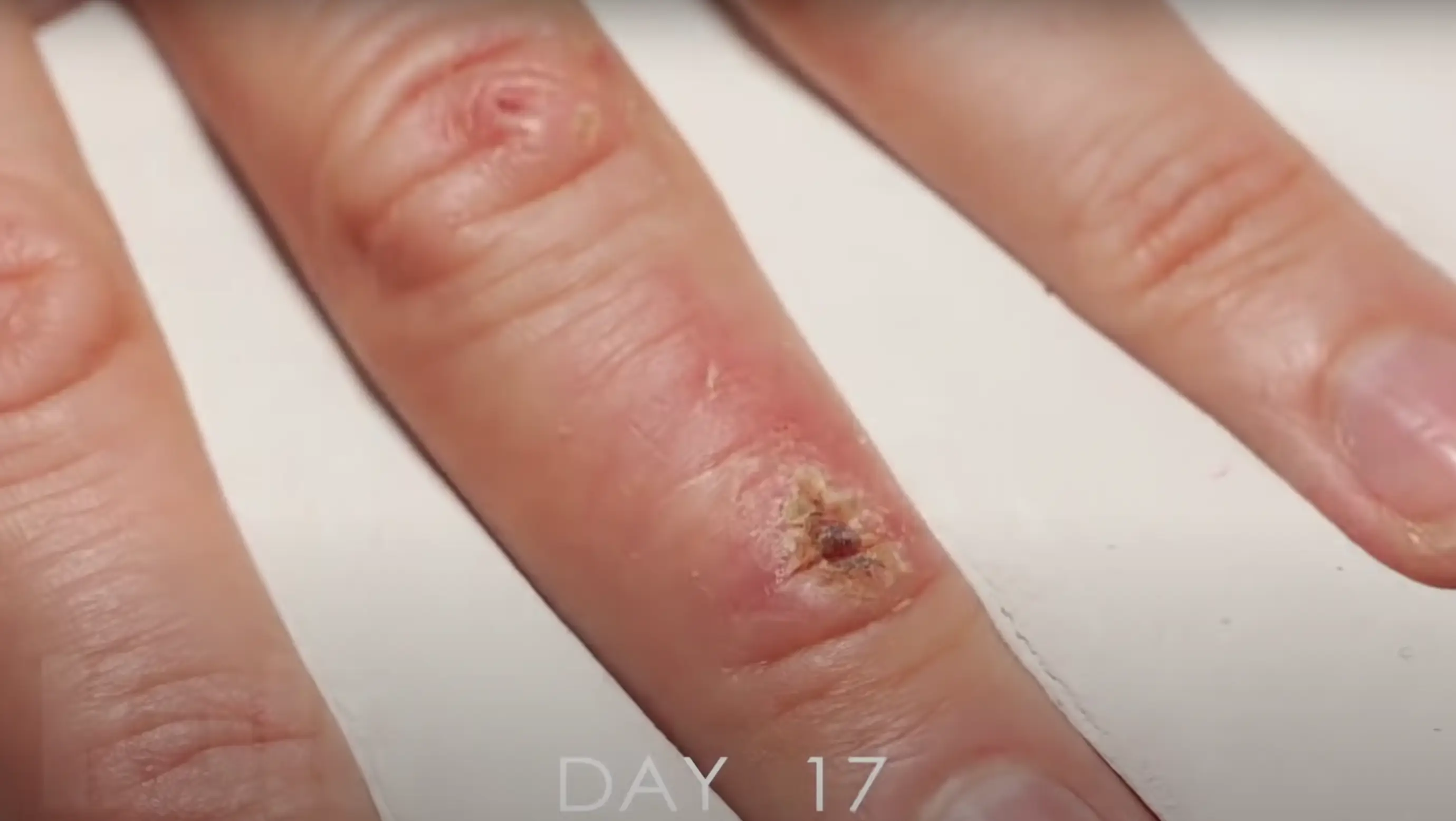 By day 17, the wound had scabbed over.