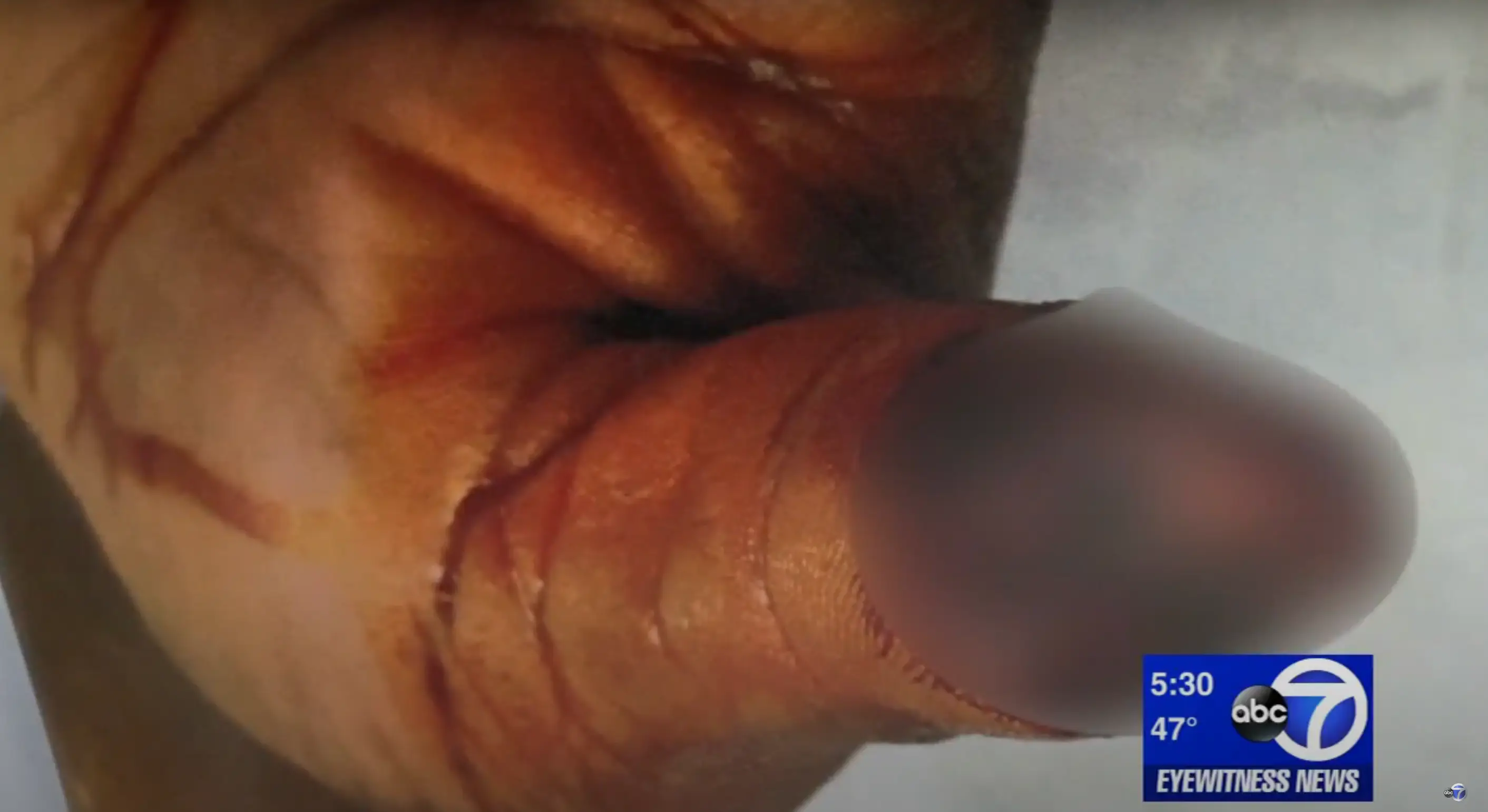 The incident saw Boateng lose the end of his thumb, and he still suffers with pain eight years later. (YouTube/Eyewitness News ABC7NY)