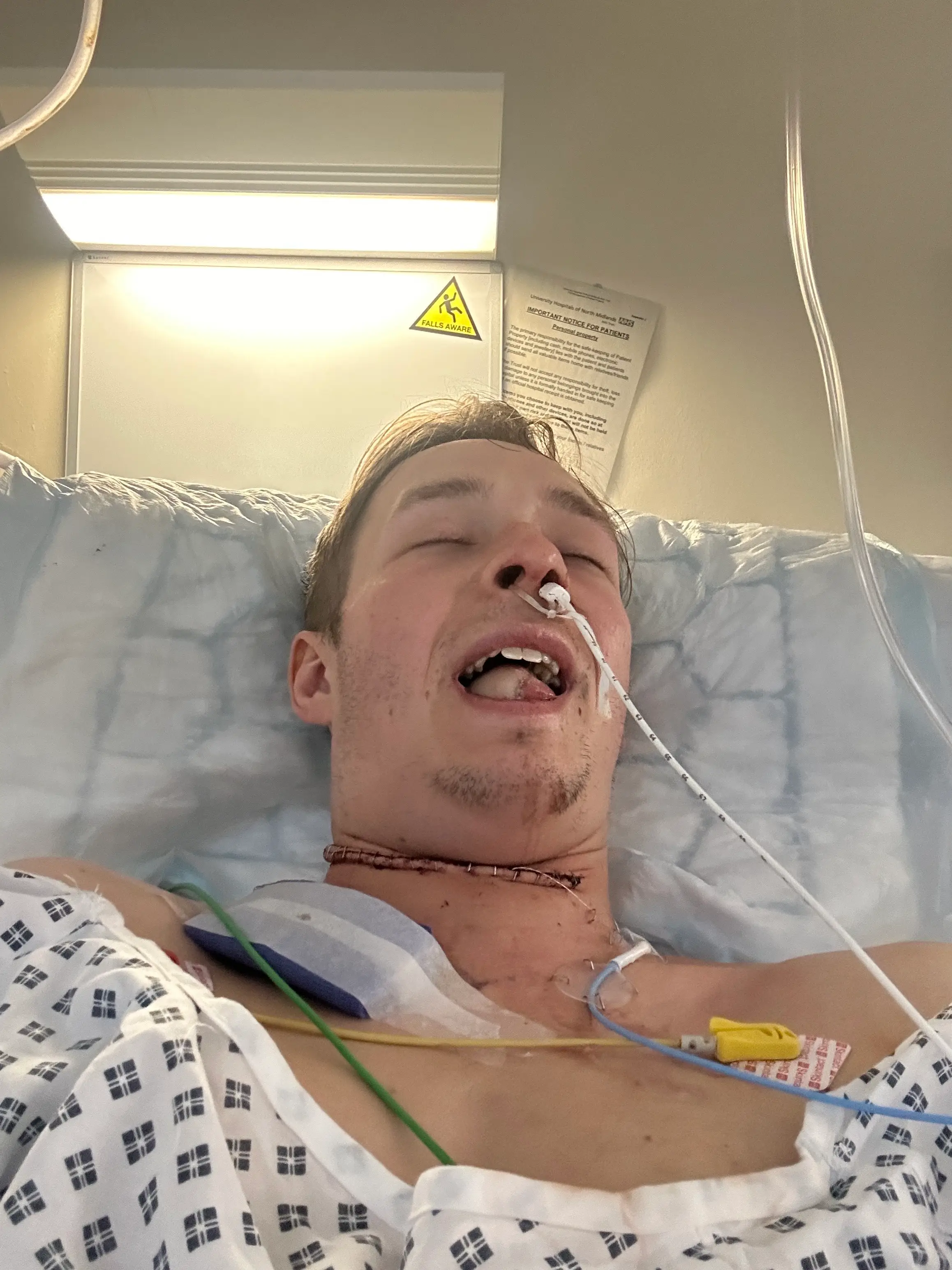 Dan was forced to have his tongue removed (SWNS)