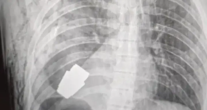 In 2023, a Ukrainian soldier survived after a grenade became lodged in his chest (Facebook/Ukraine Medical Force Command)