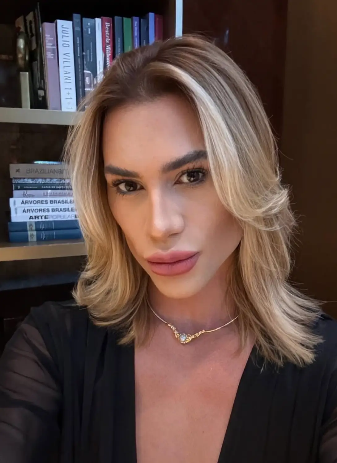 Junior Dutra allegedly shared post-surgery photos showing swelling and bruising around his eyes (Junior Dutra/Instagram)