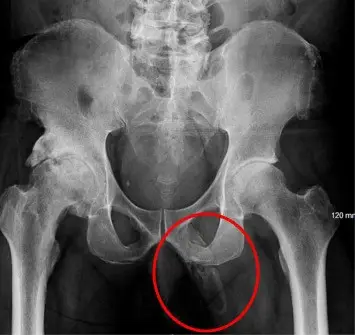Doctor's found evidence of calcification on the man's penis (Urology Case Reports)