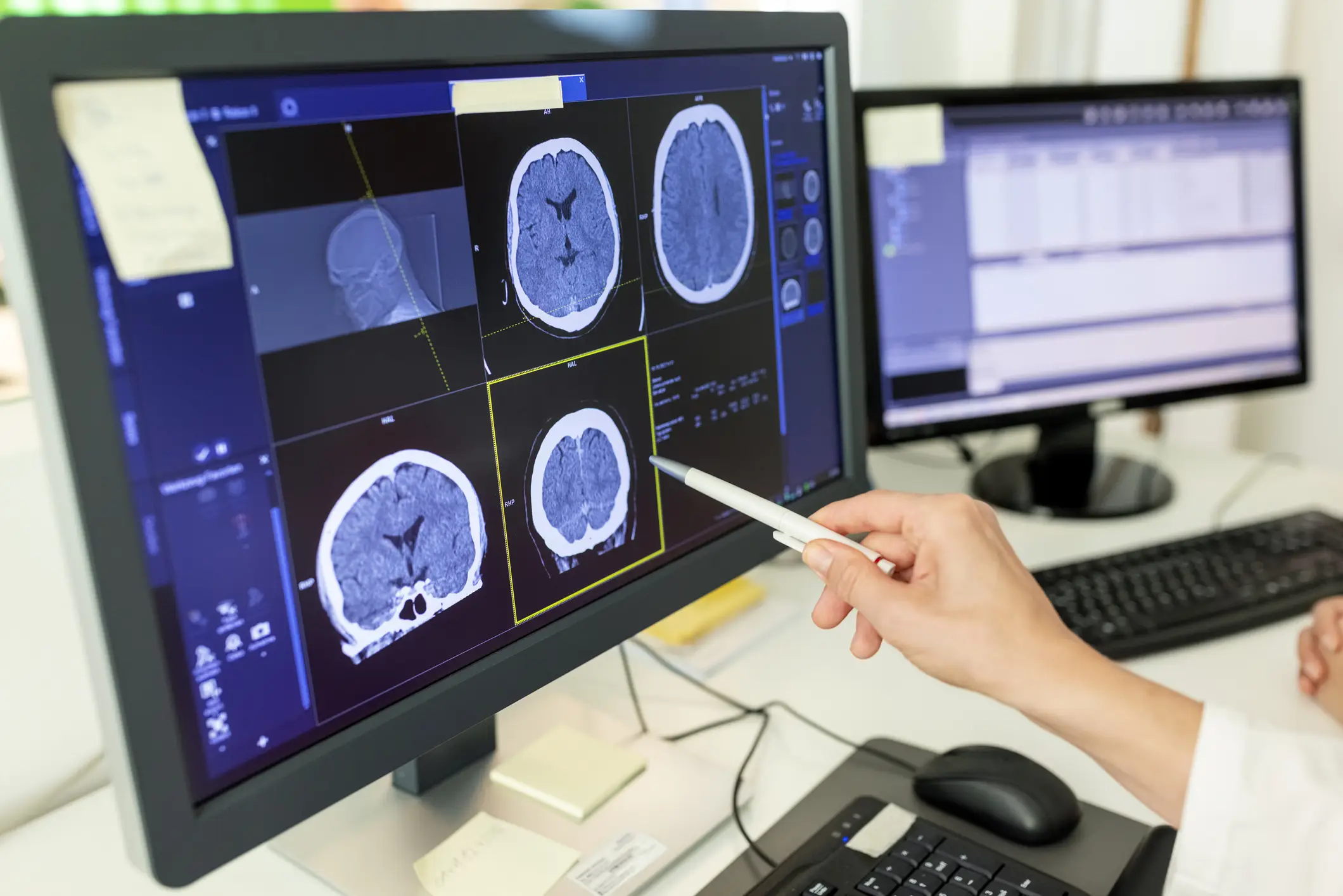 A hospital scan revealed that the 10-year-old had an aggressive diffuse midline glioma tumor in her brain (Getty Stock)