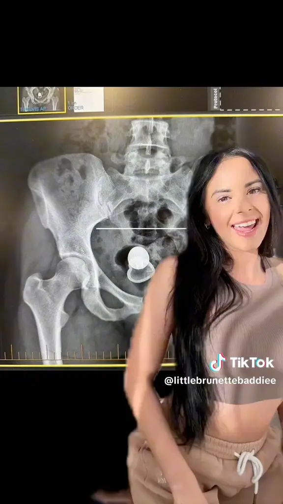 A sex toy mishap sent Alicia to the ER (TikTok/littlebrunettebaddiee)