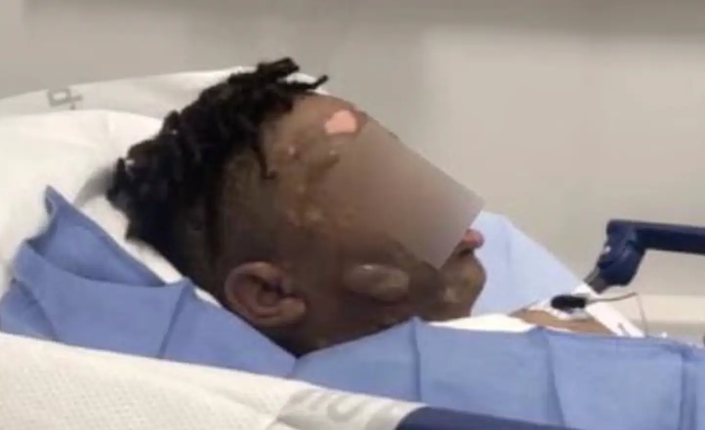 The boy's burns were so bad that he needed surgery (WALB)