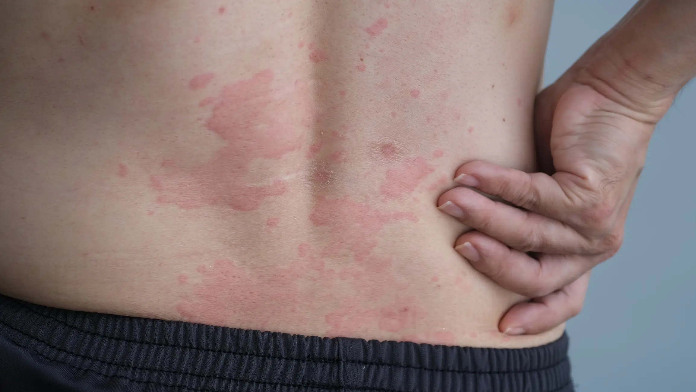 Breaking out in hives could be a symptom of AGS (Wisely/Getty Images)