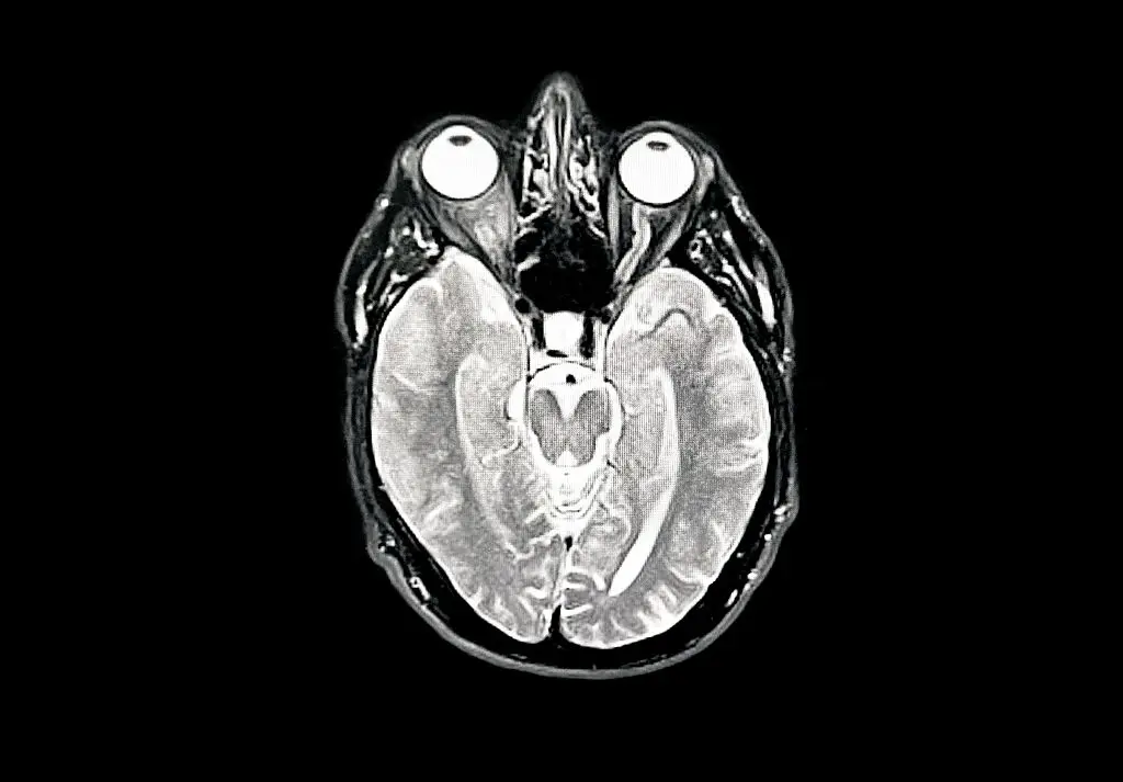 An MRI Scan of a brain showing early Dementia (Peter Dazeley/Getty Images)