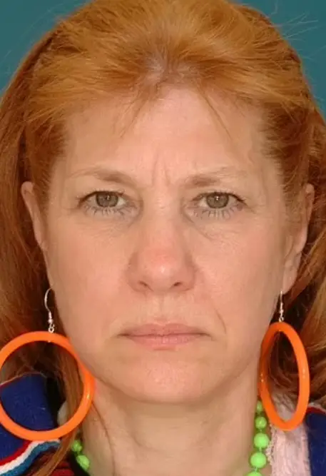 Janet had less prominent wrinkles than her twin sister Jean and less obvious bags under her eyes having been happily married for three decades (Dr. Bahman Guyuron / American Society of Plastic Surgeons)