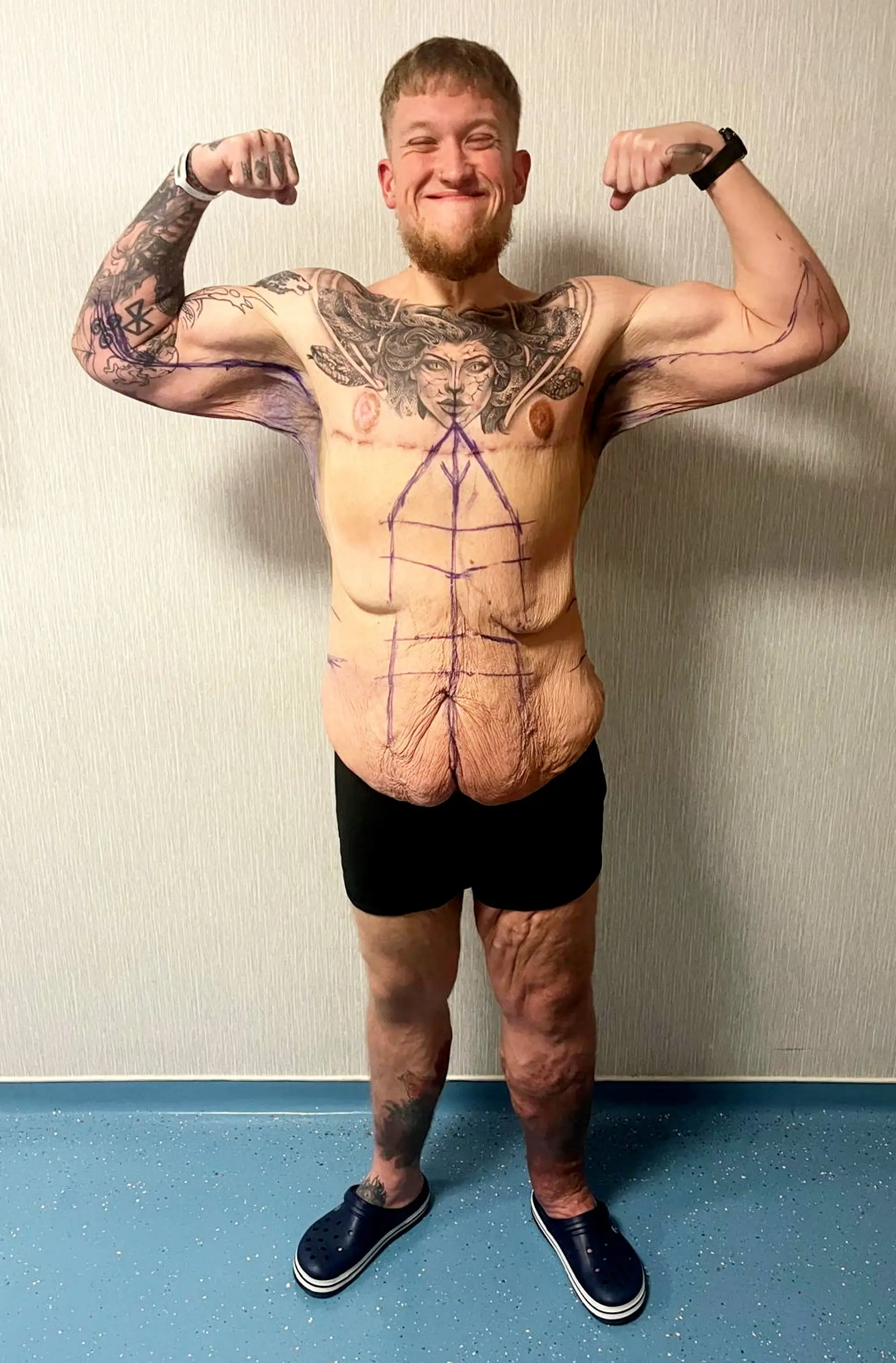 Jack also had surgery to remove excess skin (SWNS)