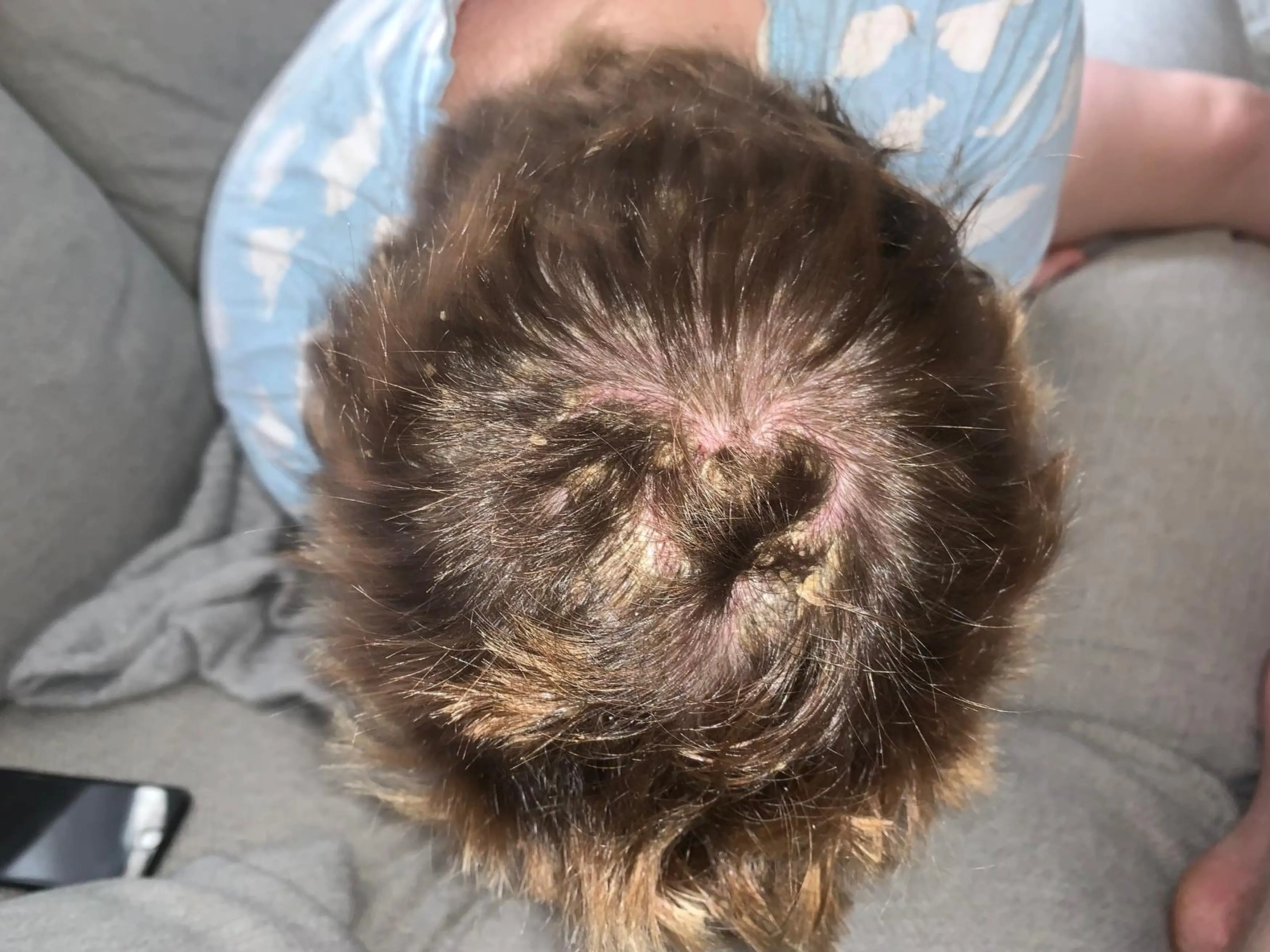 Leonie had the patches all over her head (Kennedy News and Media)