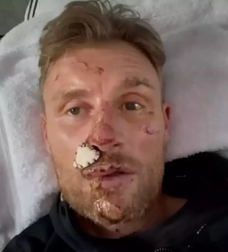 Freddie Flintoff's crash left him with broken ribs and facial scarring (BBC)