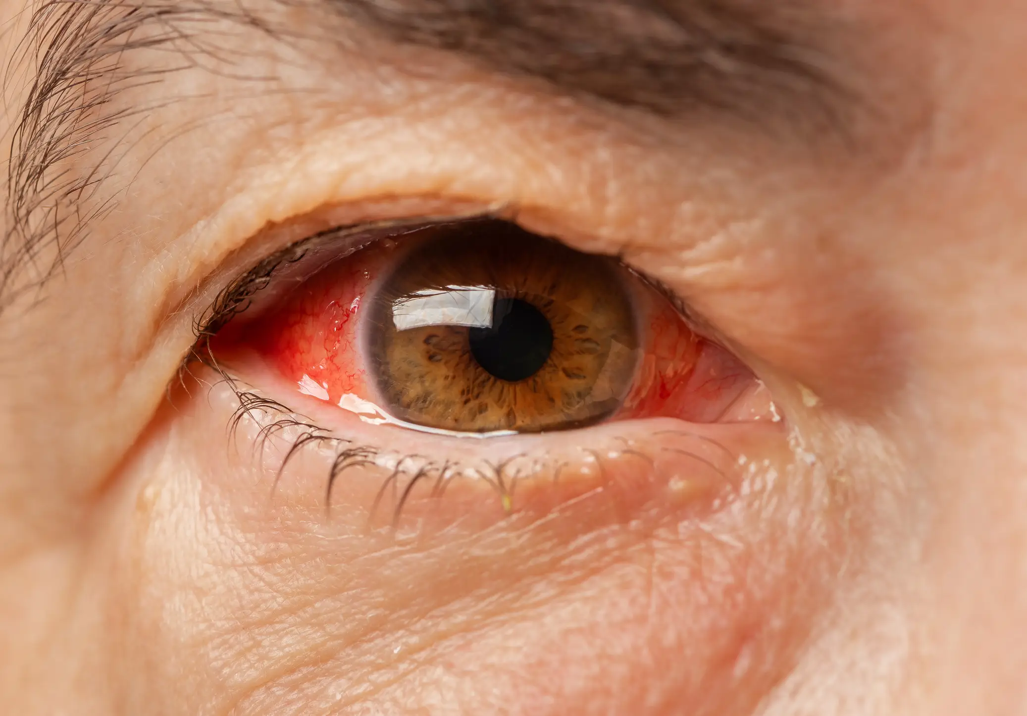 Symptoms of Acanthamoeba Keratitis can include redness, swelling, pain and itching of the eye. (Getty Stock Images)