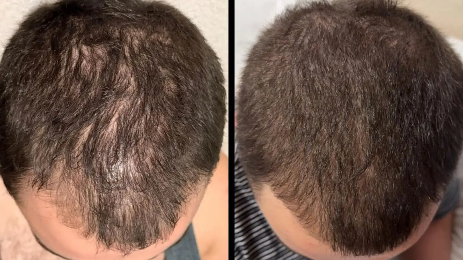 Men’s hair growth treatment improves receding hairline in 'three months' and is now only £23