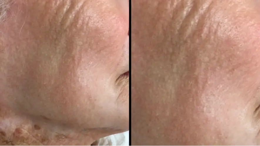 Woman who only wore sun protection on her face for 40 years shows shocking impact it had on her neck