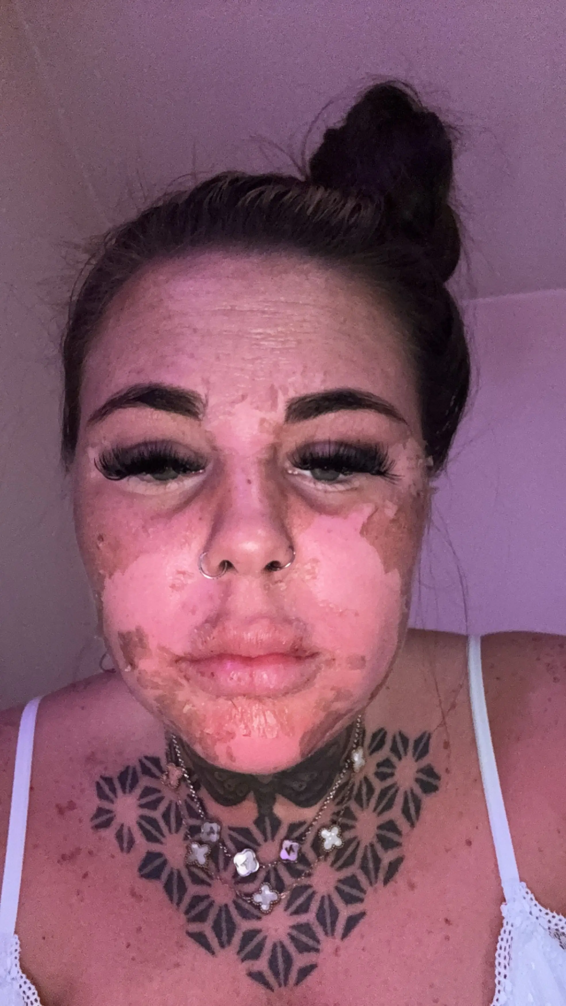 The influencer was left with a completely burnt face that would go on to blister and cause her agony (Kennedy News and Media)