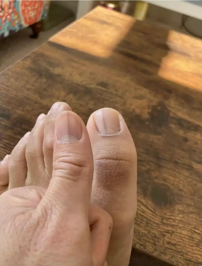 The lines on the nail shared by the user (Reddit) 