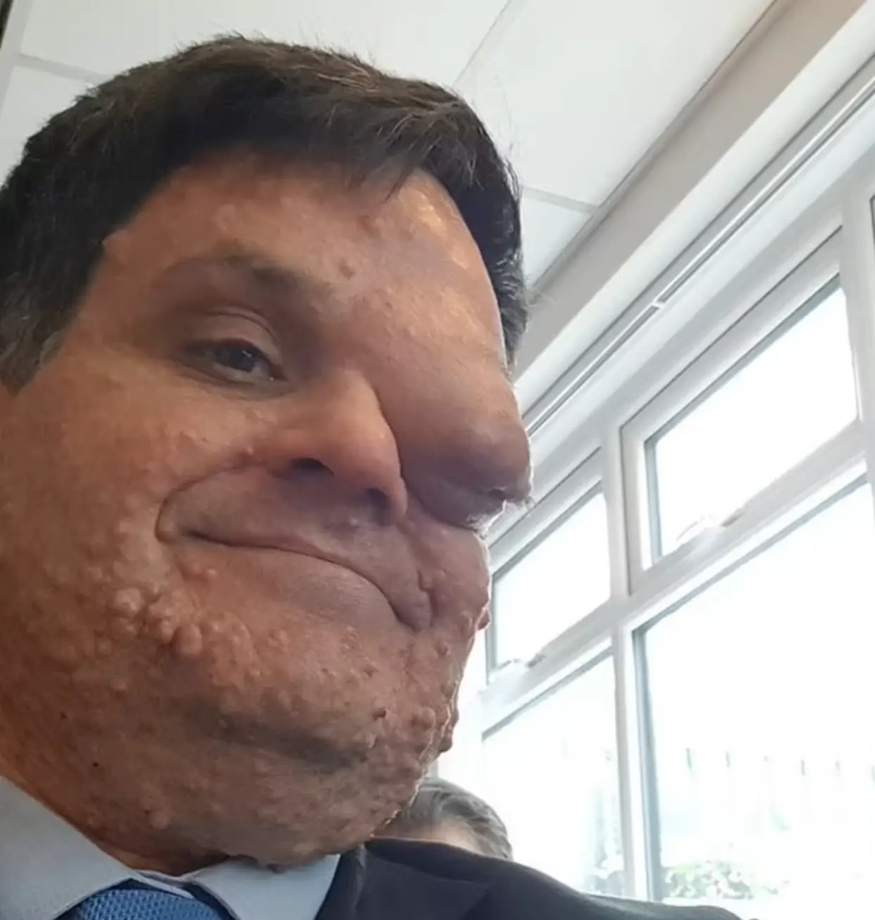 Oliver Bromley has Neurofibromatosis Type 1 (Oliver Bromley)