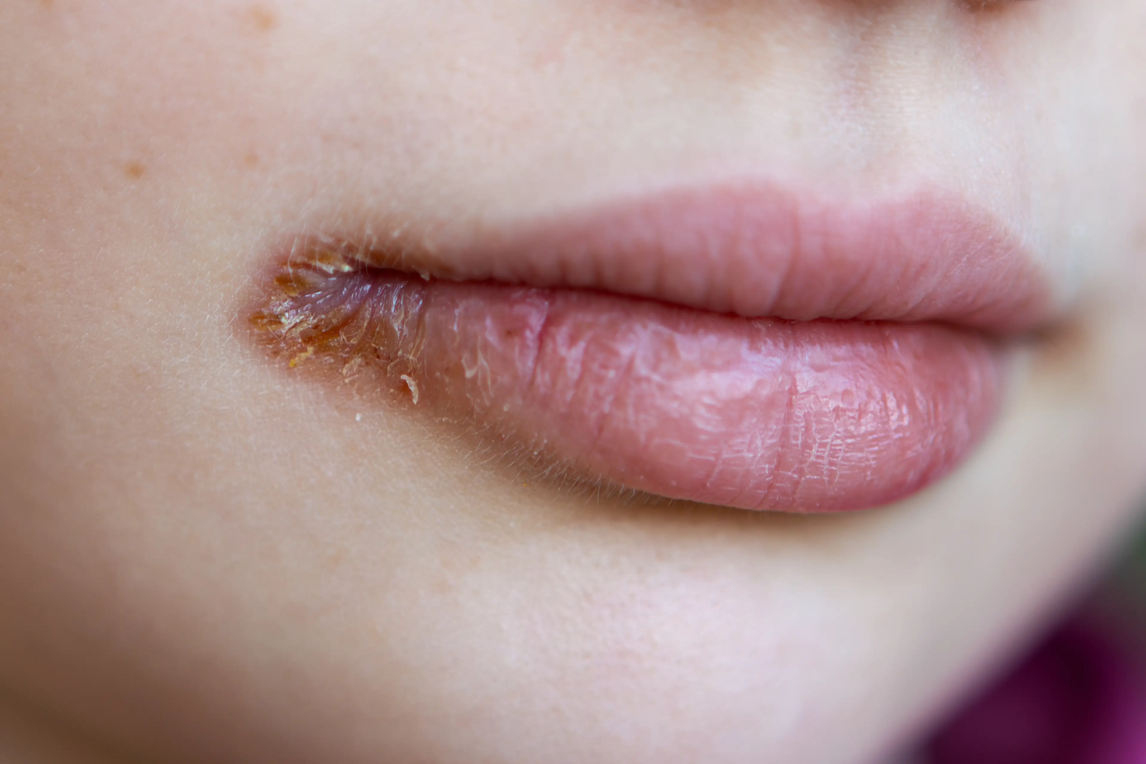Cracked lips can sting (Getty Stock)