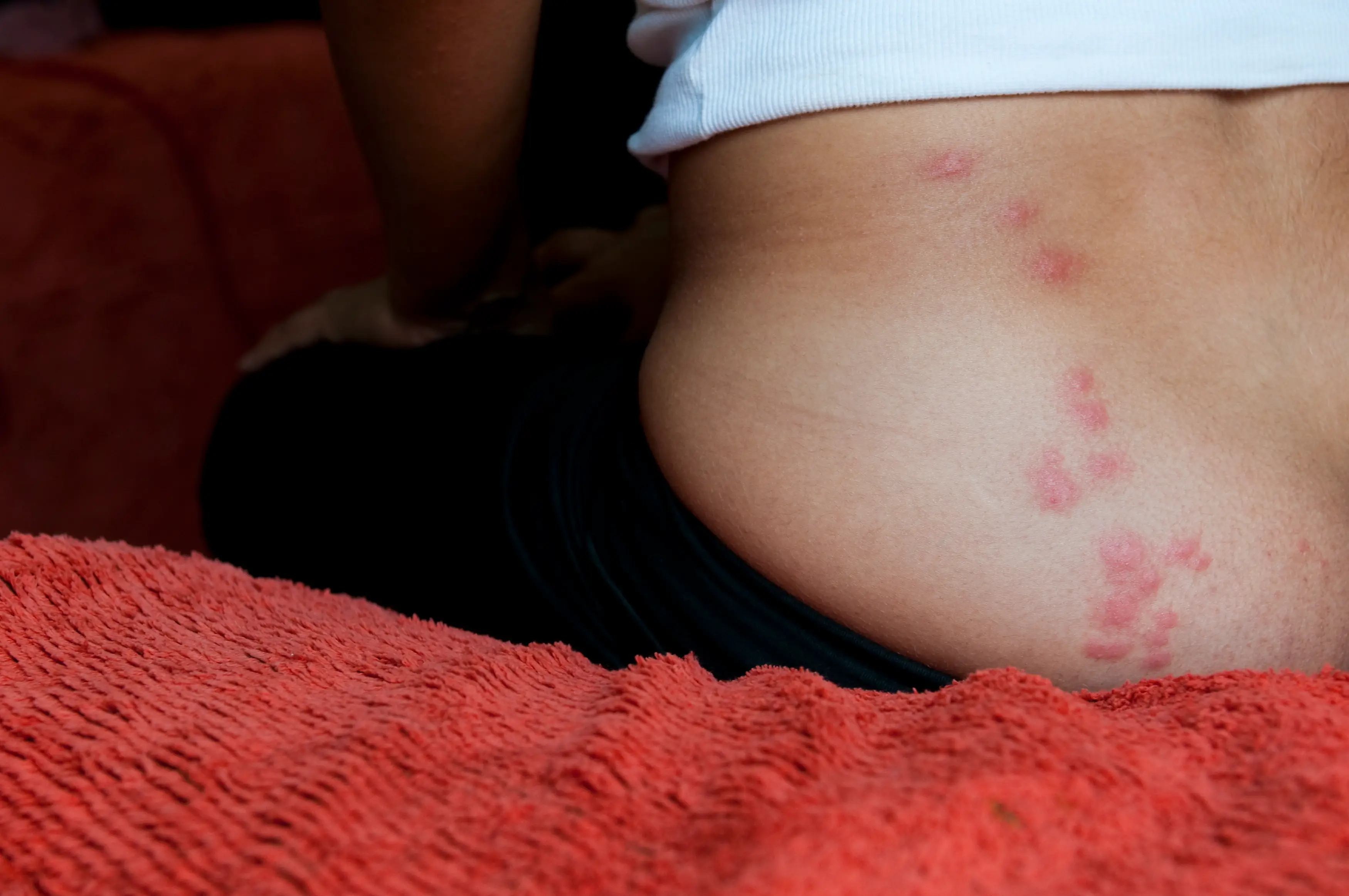 Small itchy bites can be one of the first signs of bedbugs (Getty stock image)