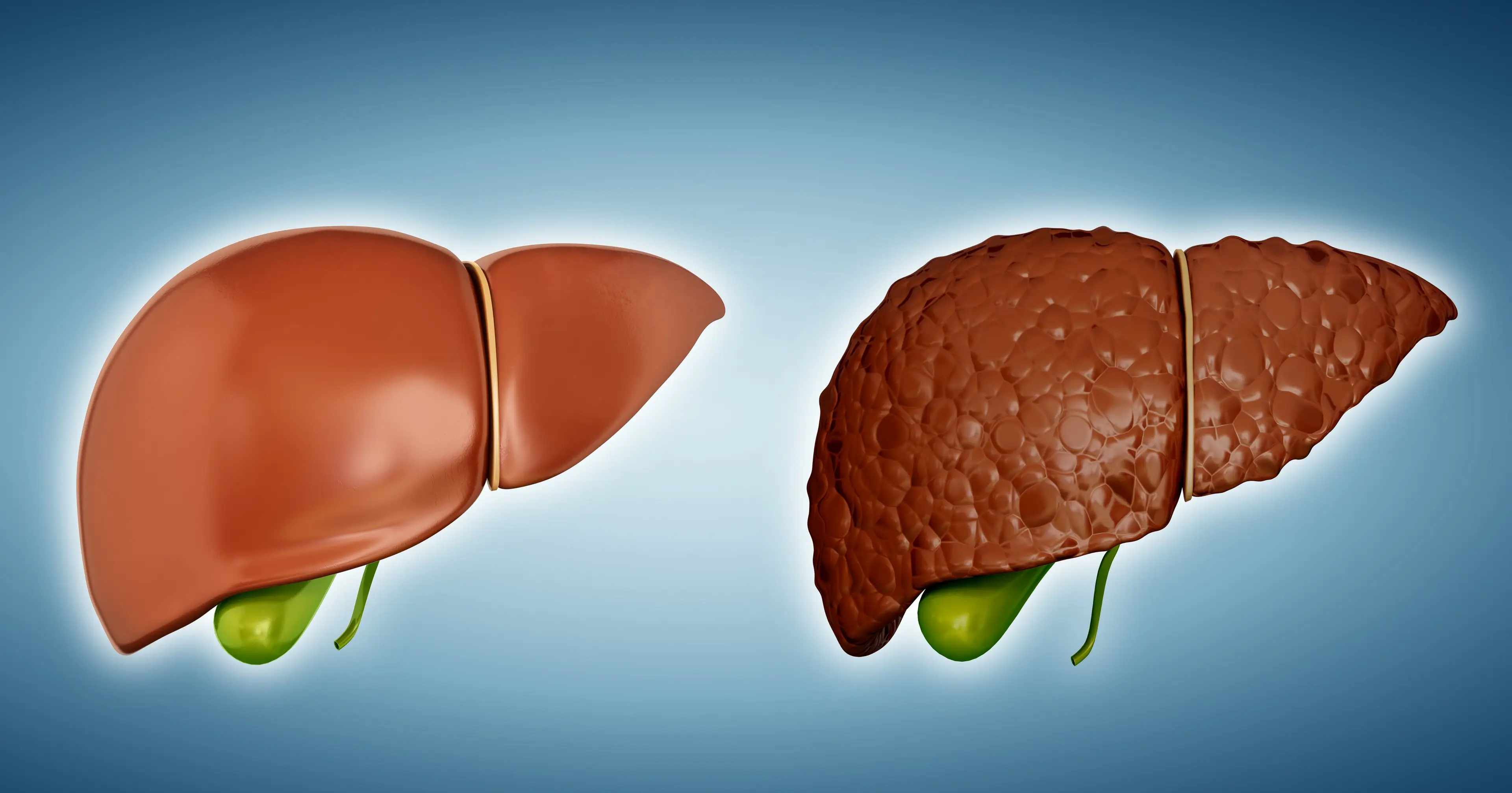Cirrhosis, a permanent scarring of the liver, develops as the disease progresses (Getty Stock Images)