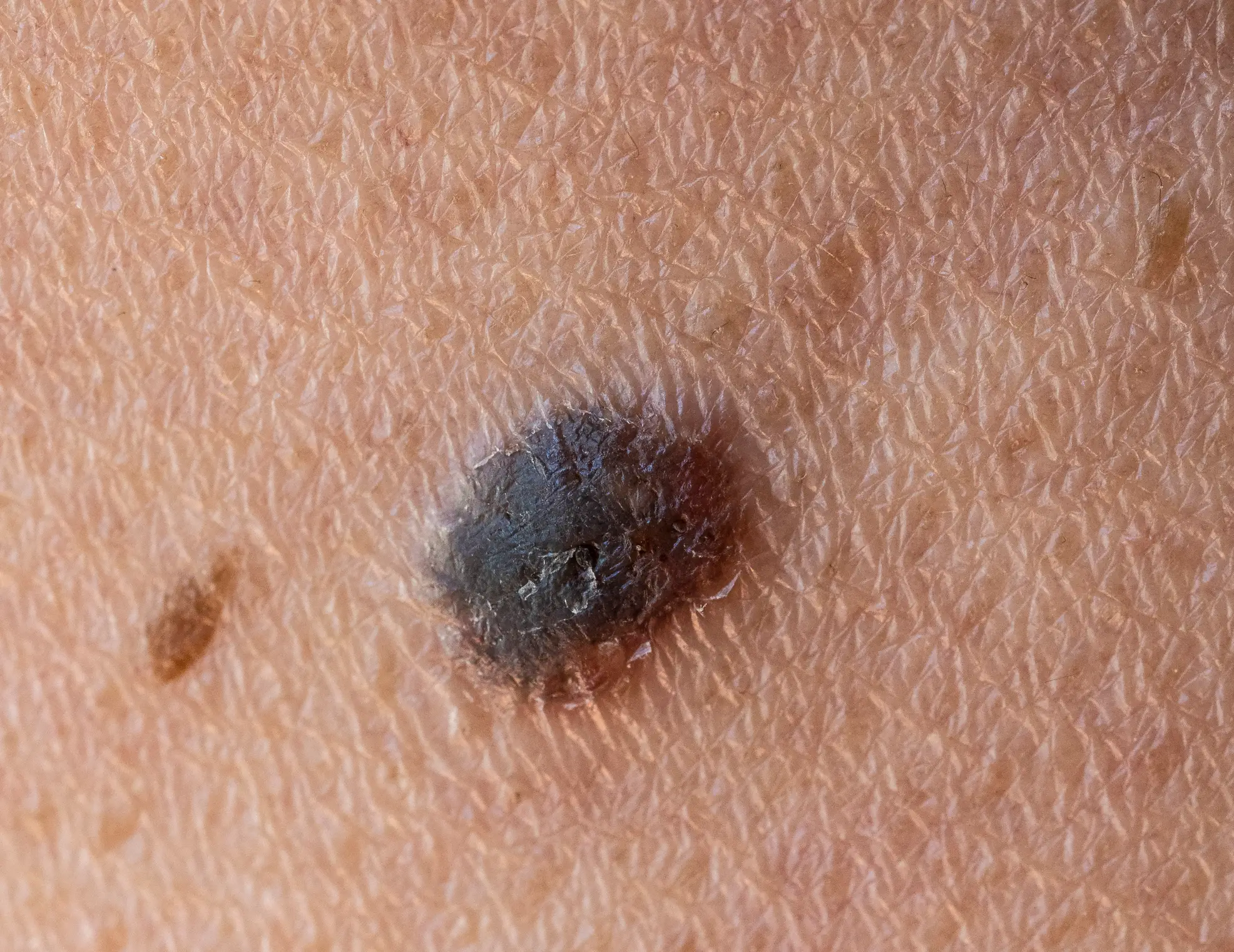 There are several cancer vaccines going through trials, but the one furthest along is for the deadly skin cancer melanoma (Getty Stock Photo)