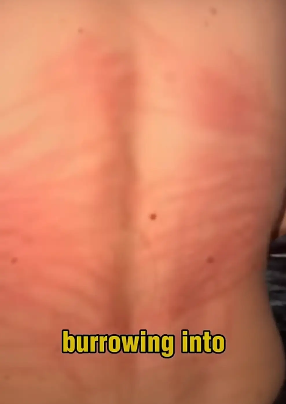 He suffered from some intense rashes after the swim (YouTube/Gnarly Charlie)