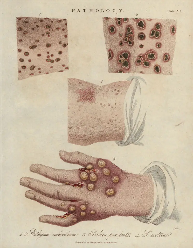Scabies is a condition which was widespread during Victorian England (Florilegius/Universal Images Group via Getty Images)