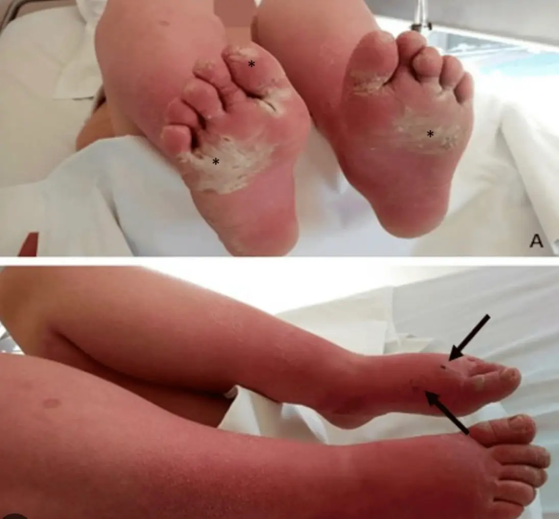 An example of a patient suffering from erythromelalgia (National Library of Medicine)