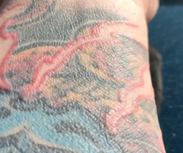 Red ink specifically is thought to be the culprit (Mateuszczyk MK et. al (2025))