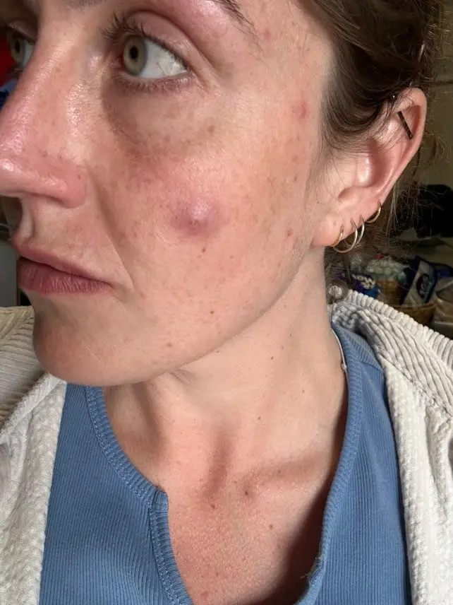 Steph Warkotsch spotted the 'blemish' on her left cheek in October last year (SWNS)